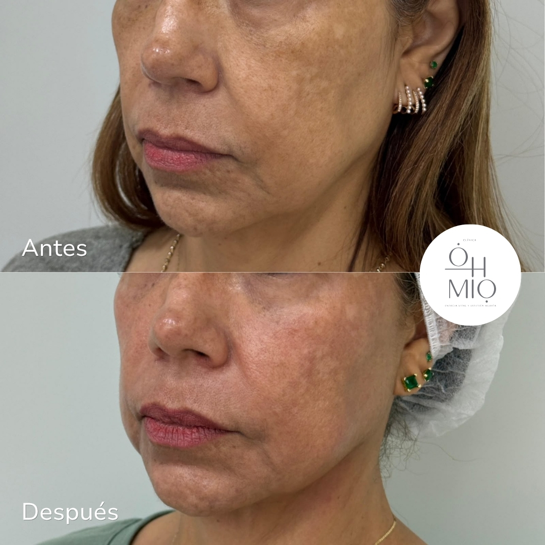 Antes y después de tratamiento con Ultraformer MPT en perfil de mandíbula, paciente de Clínica Ohmio