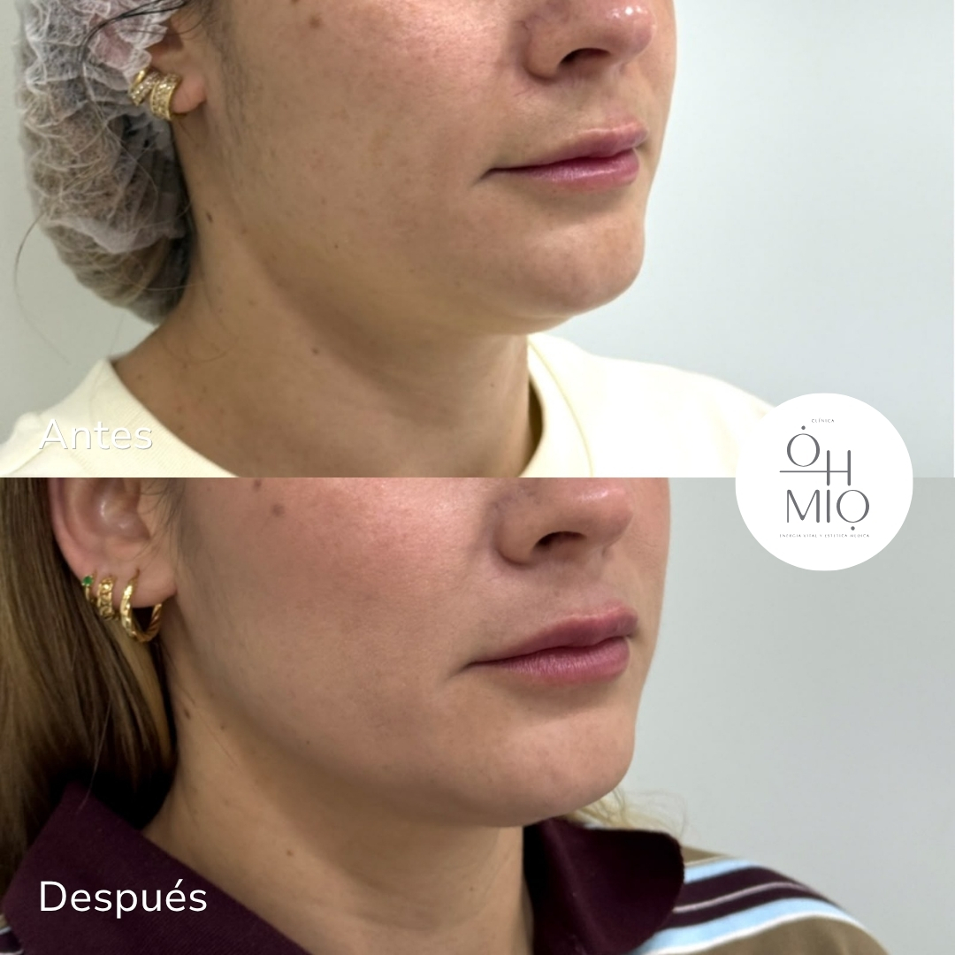 Antes y después de tratamiento con Ultraformer MPT en contorno facial, paciente de Clínica Ohmio