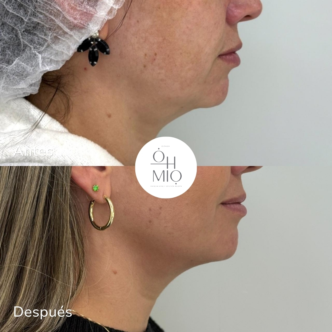 Antes y después de tratamiento con Ultraformer MPT en línea de mandíbula y cuello, paciente de Clínica Ohmio